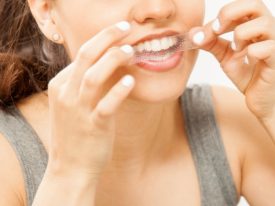 Lingual Braces Hawthorn – Expert Care for a Perfect Smile
